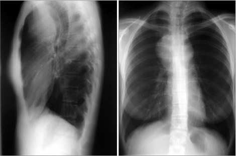 Chest X-ray revealed an expansive anterior mediastinal | Open-i