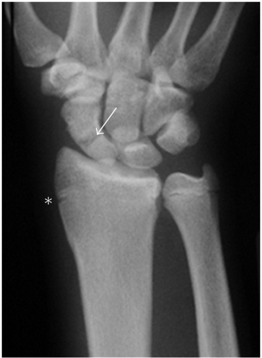 Plain coronal radiograph suggesting fracture at the wai | Open-i