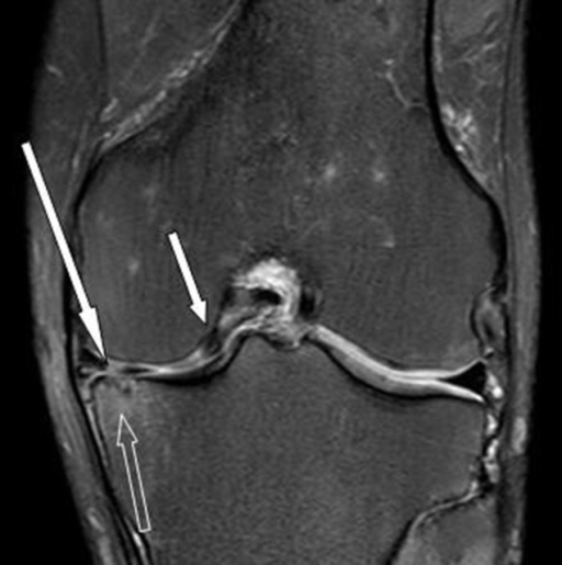 A fat-suppressed, PD-w image in the coronal plane of th | Open-i