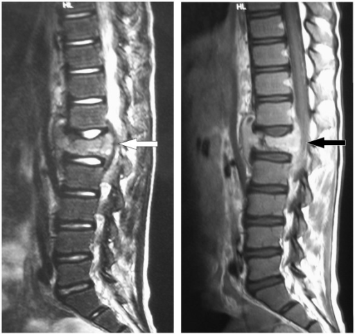 MRI (T1 and T2 weighted images) of lumbar spine. Invest | Open-i