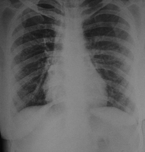 chest x ray shows prominent bronchovascular markings open i how to write a book report in 5th grade