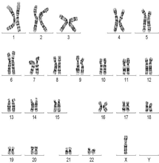 G-banded karyotype showing a cell line with monosomy X. | Open-i