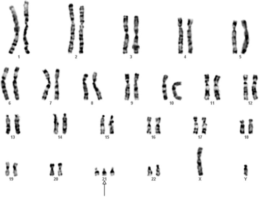 Karyotype of the infant from FRHM family (K) diagnosedw | Open-i