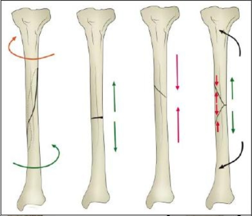 Spiral fractures result from torque, transverse lines a | Open-i