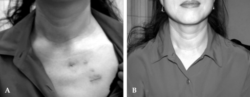 (A) Scars On The Ipsilateral Anterior Chest Wall One Mo | Open-i