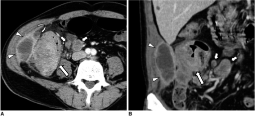 tubular adenoma transverse colon icd 10