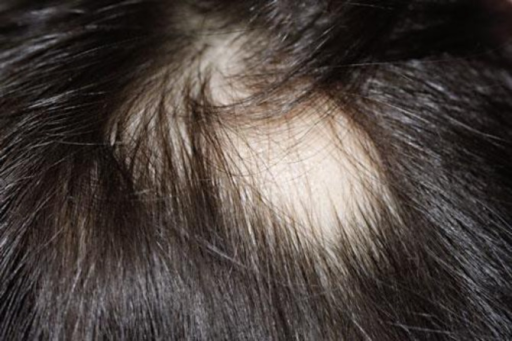 Aphlegmatic Patch Of Alopecia With Angular Contours. 