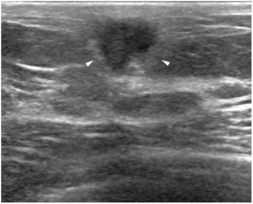 Ultrasonography at the 12 o’clock position of the lef | Open-i