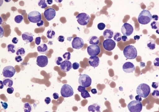 Bone marrow aspirate of chronic phase chronic myeloid l | Open-i