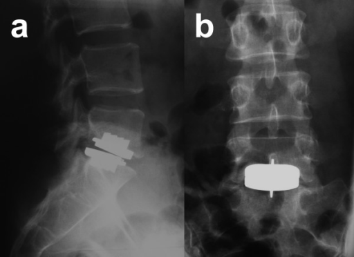 A 42year old female patient with degenerative disc dis