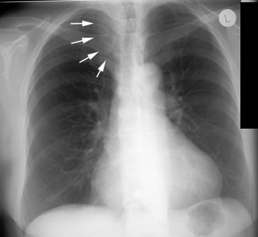 Preoperative chest x-ray displayed a mediastinal enlarg | Open-i