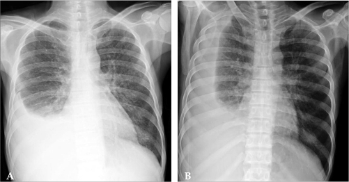 Lateral Decubitus X Ray