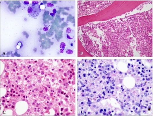 Bone marrow aspirates and biopsies. (A) Bone marrow asp | Open-i