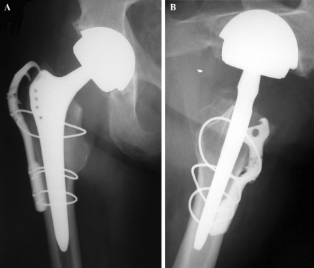 Antero-posterior (a) and axial (b) view of a type A1 fr | Open-i