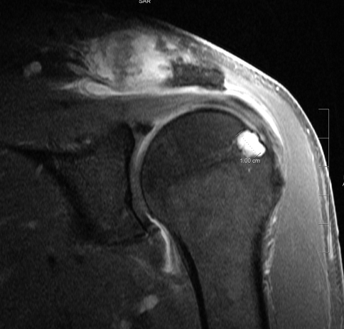 shoulder erosion humeral head joint left coronal t1 2009 fig2 contrast bursitis ac subdeltoid hemochromatosis bursa related policy copyright synovial