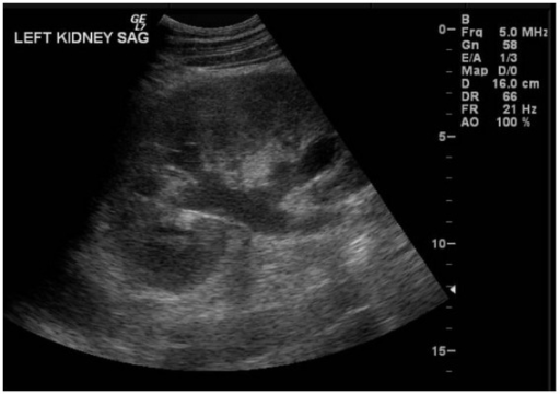 Hydronephrosis Ultrasound 9251