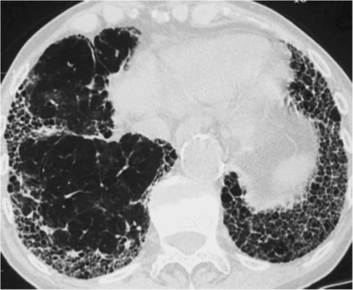 CT scan of thorax in a patient with IPF showing typical | Open-i