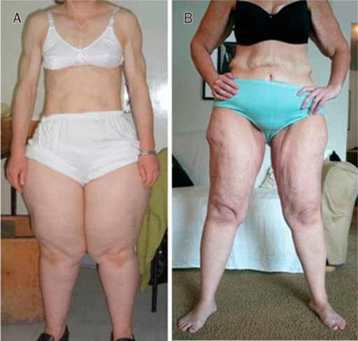 Acquired Partial Lipodystrophy And Lipedema A A 37 Ye Open I