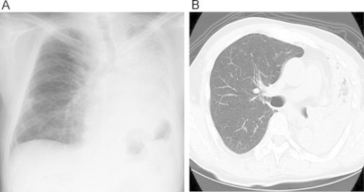 (A) Chest X-ray at 1 month after patient’s first visi | Open-i