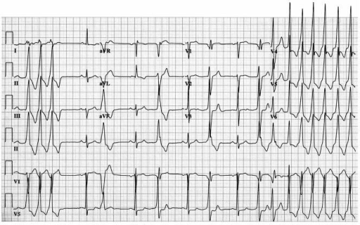 Electrocardiogram illustrating repetitive monomorphic r | Open-i