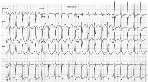 Electrocardiogram illustrating left ventricular outflow | Open-i