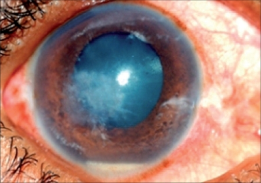 Early fungal keratitis | Open-i