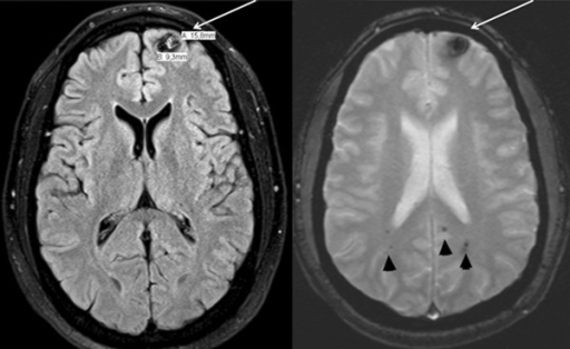 What is cerebral cavernous malformation?