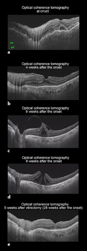 Serial OCT Images Of A Case With MH Secondary To VKH Disease Demonstrated Serial OCT Images Of A Case With MH Secondary To VKH Disease Demonstrated