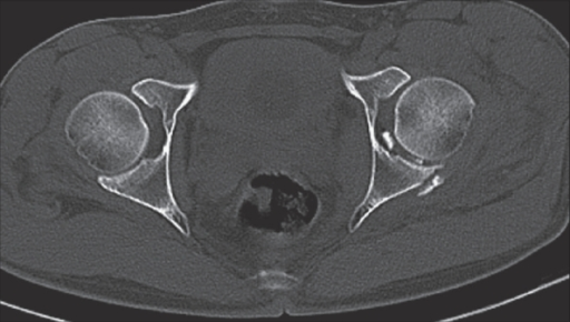 CT scan showing the retained fragments and fracture of | Open-i