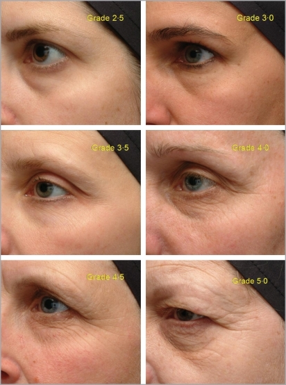 Images Illustrating The Range Of Wrinkle Severity Suita Open I 3209