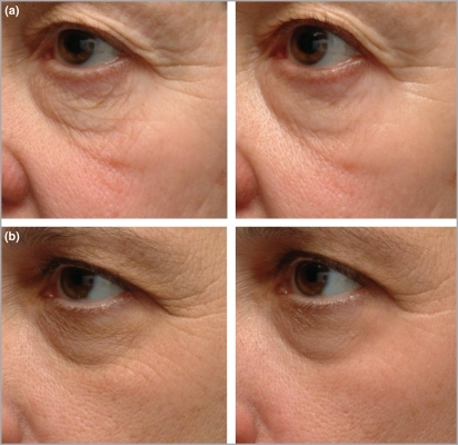 before tretinoin retin niacinamide propionate wrinkles aging retinyl peptide anti regimen vs treatment cream skin benefits results eye wrinkle weeks