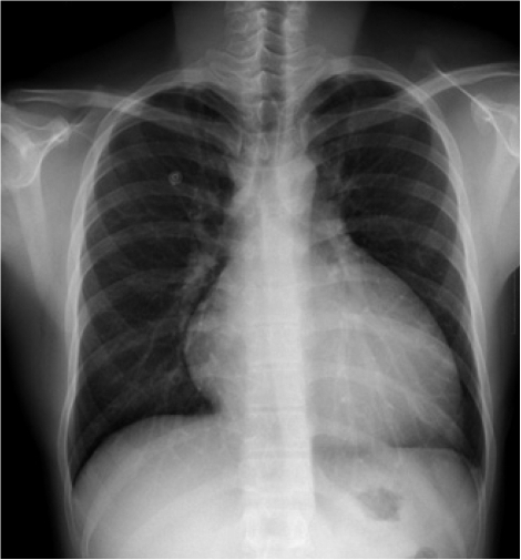 Chest X-ray on admission showed cardiomegaly with a cle | Open-i