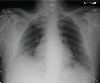 Chest radiograph revealed mild right basilar atelectasi | Open-i