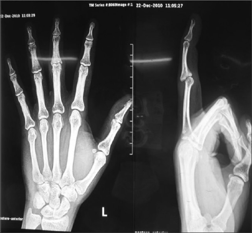 X-ray showing the deformity of the left middle finger | Open-i