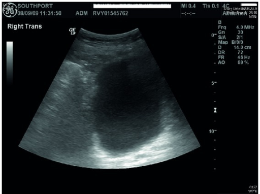 Trabeculated Bladder