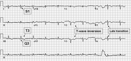 Examination Of The Admission 12 Lead Ecg Revealed Inco Open I