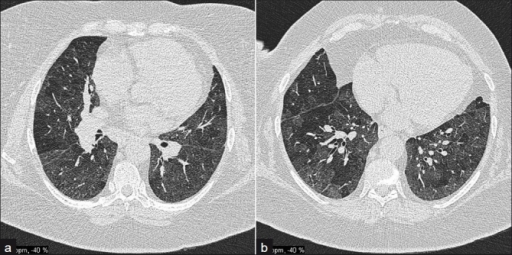 A 57-year-old male with obliterative bronchiolitis secondary to RA; (a) and (b) HRCT axial sections demonstrate marked mosaic pattern attenuation.