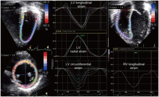 Two-dimensional Speckle Tracking Echocardiography Demon | Open-i