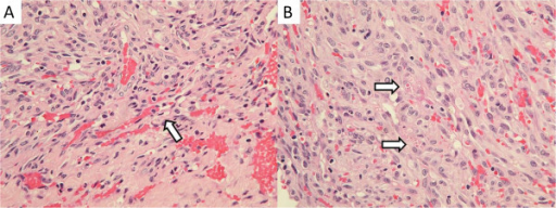 Sarcoma de Kaposi iatrogénico en la cavidad nasal