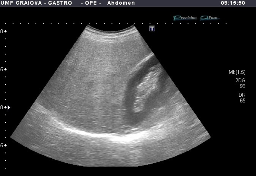 B-mode ultrasound showing hyperechoic liver comparing w | Open-i