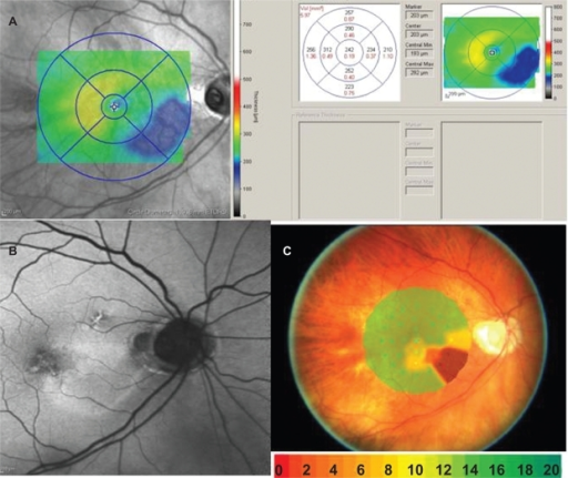 A) Retinal thickness mapping demonstrates thinning of t | Open-i