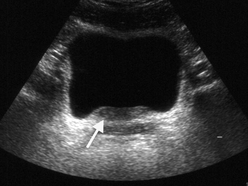 ultrasonography-shows-thickening-of-the-wall-of-the-uri-open-i