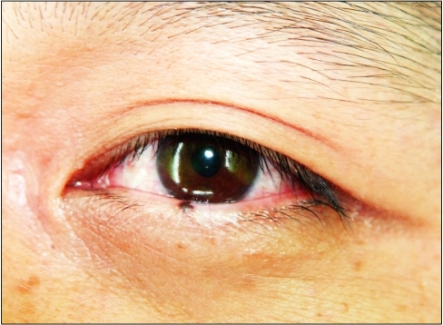 Poliosis with a melanocytic nevus on the central eyelid | Open-i