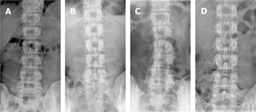 Anteroposterior lumbar radiographs. Castellvi classific | Open-i