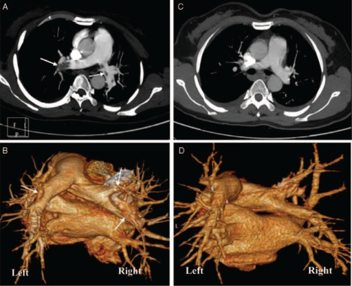 CT pulmonary angiography (CTPA) in case 1. CTPA with 2- | Open-i