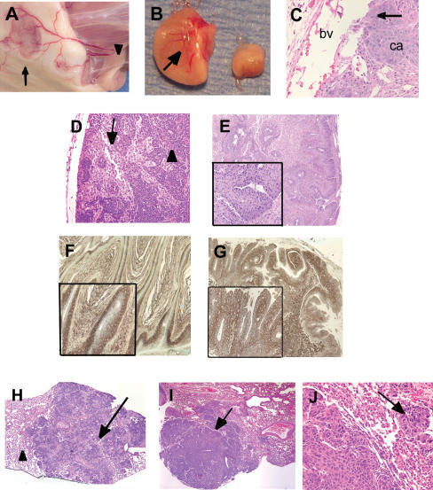 Metastasis Of Primary Scc To Lymph Nodes And Lungs In P Open I 