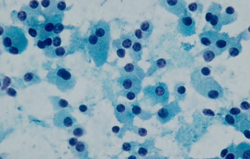 Hurthle Cells Cytology