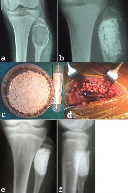 A Preoperative X Ray Of Knee Ap View A Shows A Cavi Open I 7028