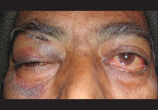 Photograph Showing Proptosis With Conjunctival Chemosis Open I