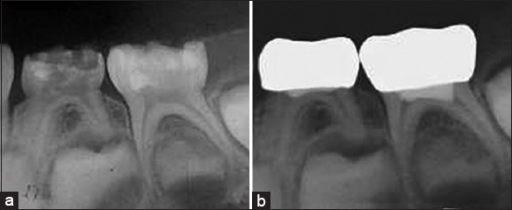 Radiographic features of the teeth treated with formocr ...